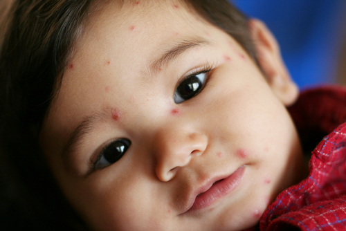 Everything you need to know about chickenpox